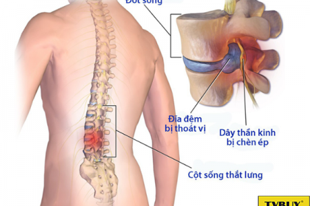 Phát hiện thoát vị đĩa đệm từ chứng đau lưng