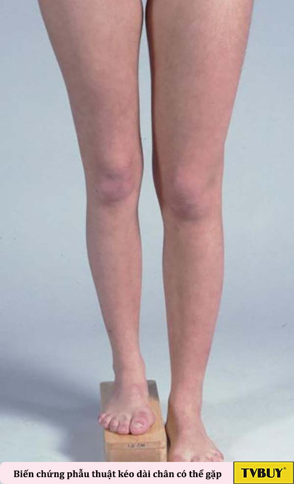 biến chứng có thể gặp khi phẫu thuật kéo dài chân