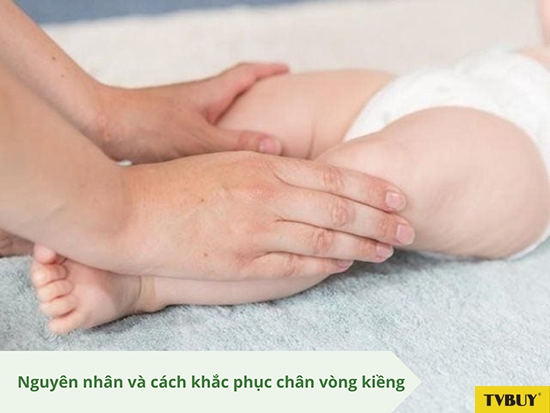 Chân vòng kiềng là dị tật thường gặp ở trẻ sơ sinh và trẻ nhỏ